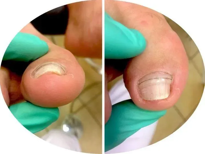 Ongles incarnés près de Beaupréau